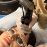 جلسة تشقير وجه مع حواجب بالليزر مع رتوش